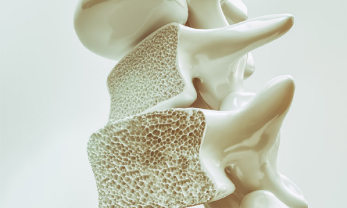 骨粗鬆症(骨粗しょう症) イメージ